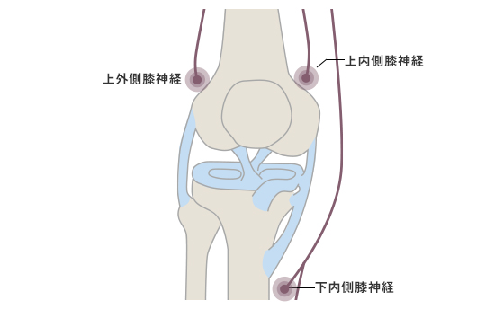 変形性ひざ関節症